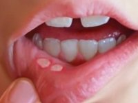 Ağızda su kabarcığı neden olur? Pemfigus nedir?