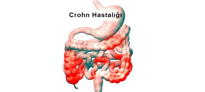 crohn-hastaligi-mide-2.jpg
